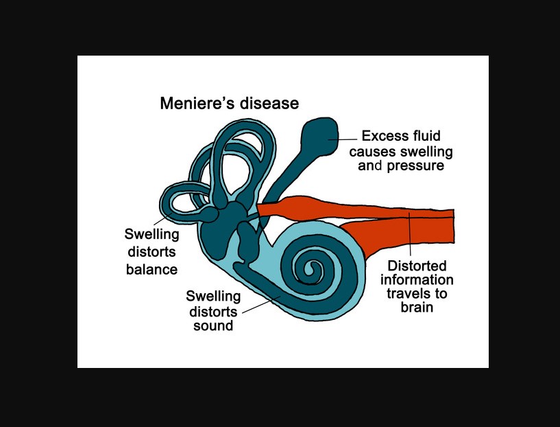 Meniere’s Disease